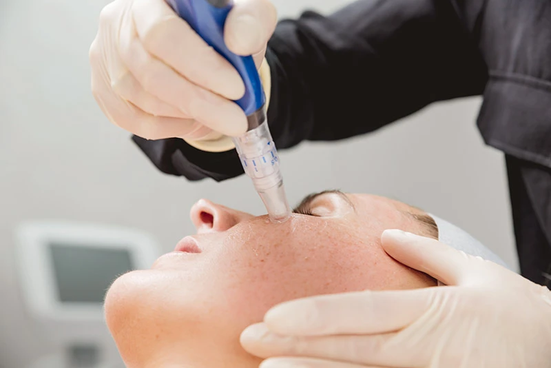 SkinPen Micro Needling - The Clinic Bondi