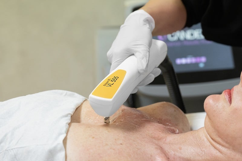IPL pigmentation treatment on the chest - The Clinic Bondi