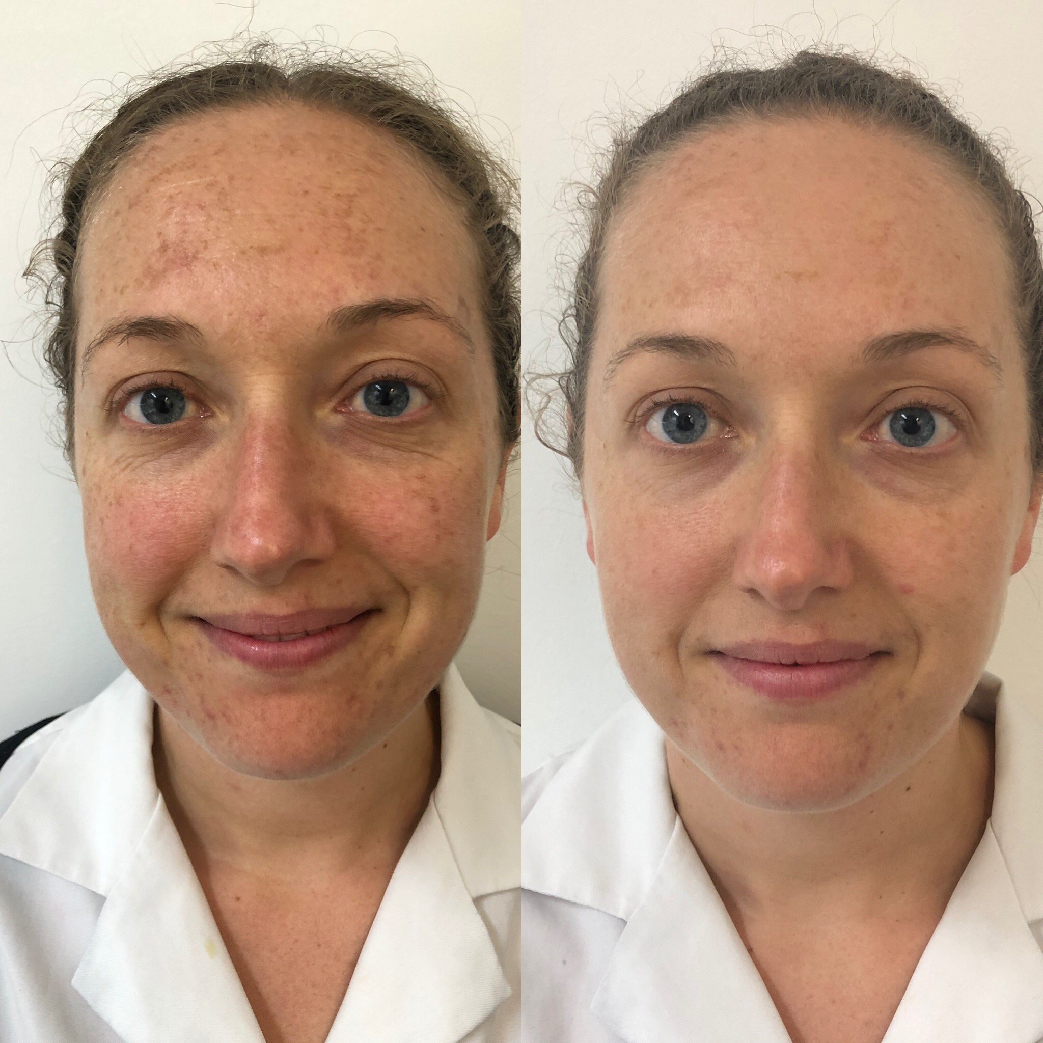 IPL Before and after result photo - The Clinic Bondi