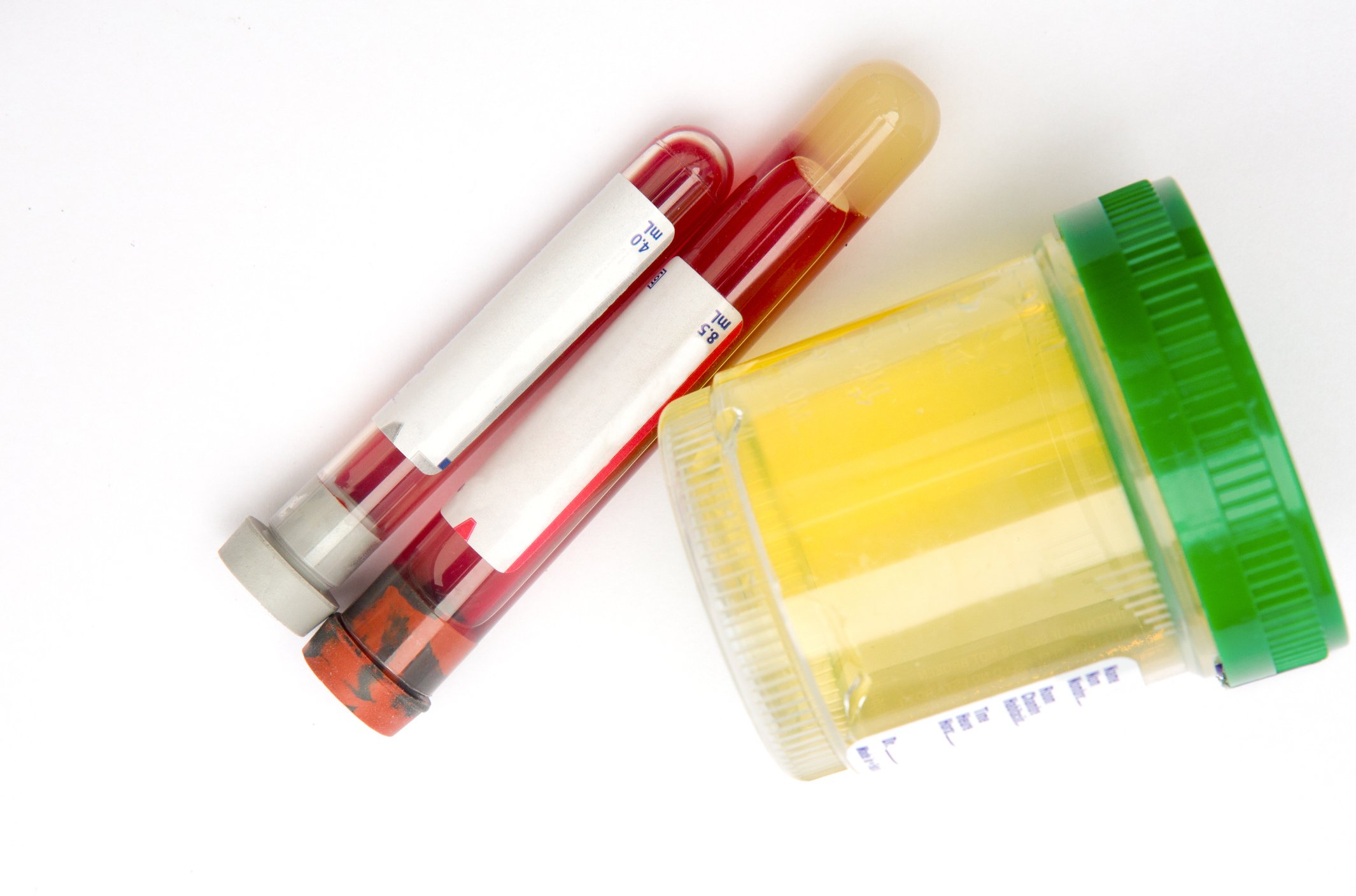 Urine sample and blood test