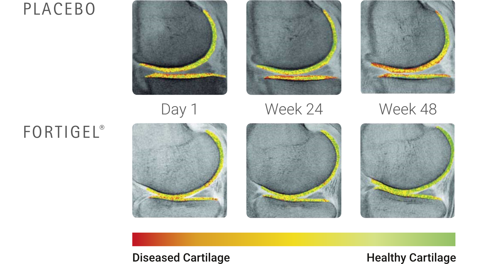 U Perform FORTIGEL Bioactive Collagen Peptides Clinical Results Bar Chart Cartilage Scans