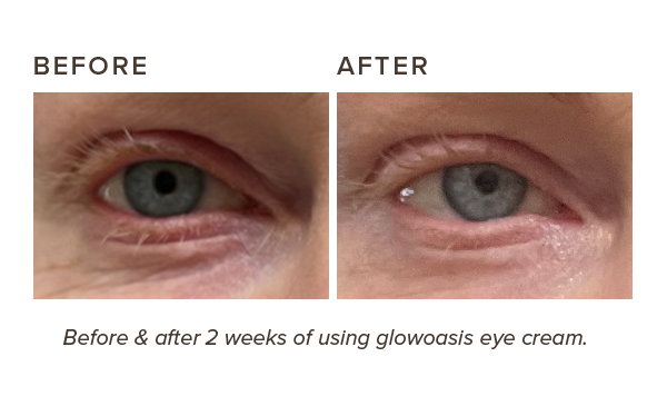 before & after results of glowoasis vegan probiotics and triple peptide refreshing anti aging eye cream after 2 weeksbefore & after results of glowoasis vegan probiotics and triple peptide refreshing anti aging eye cream after 2 weeks