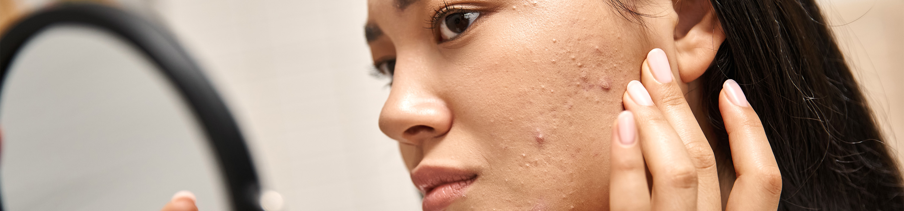 Close-up view of a woman checking her acne-prone skin in the mirror.
