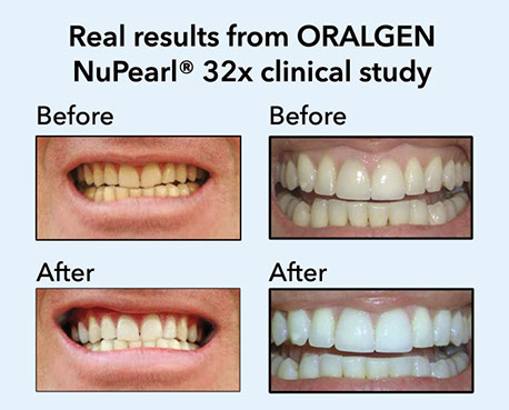 oralgen nupearl pro