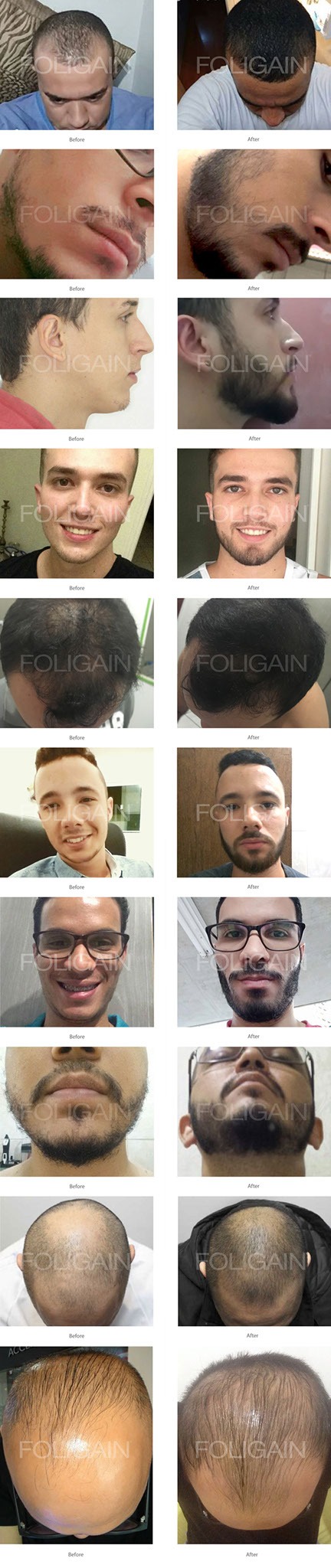 Skorpe forstørrelse snemand FOLIGAIN Advanced Hair Regrowth For Men Minoxidil % + Trioxidil 5% (Ex