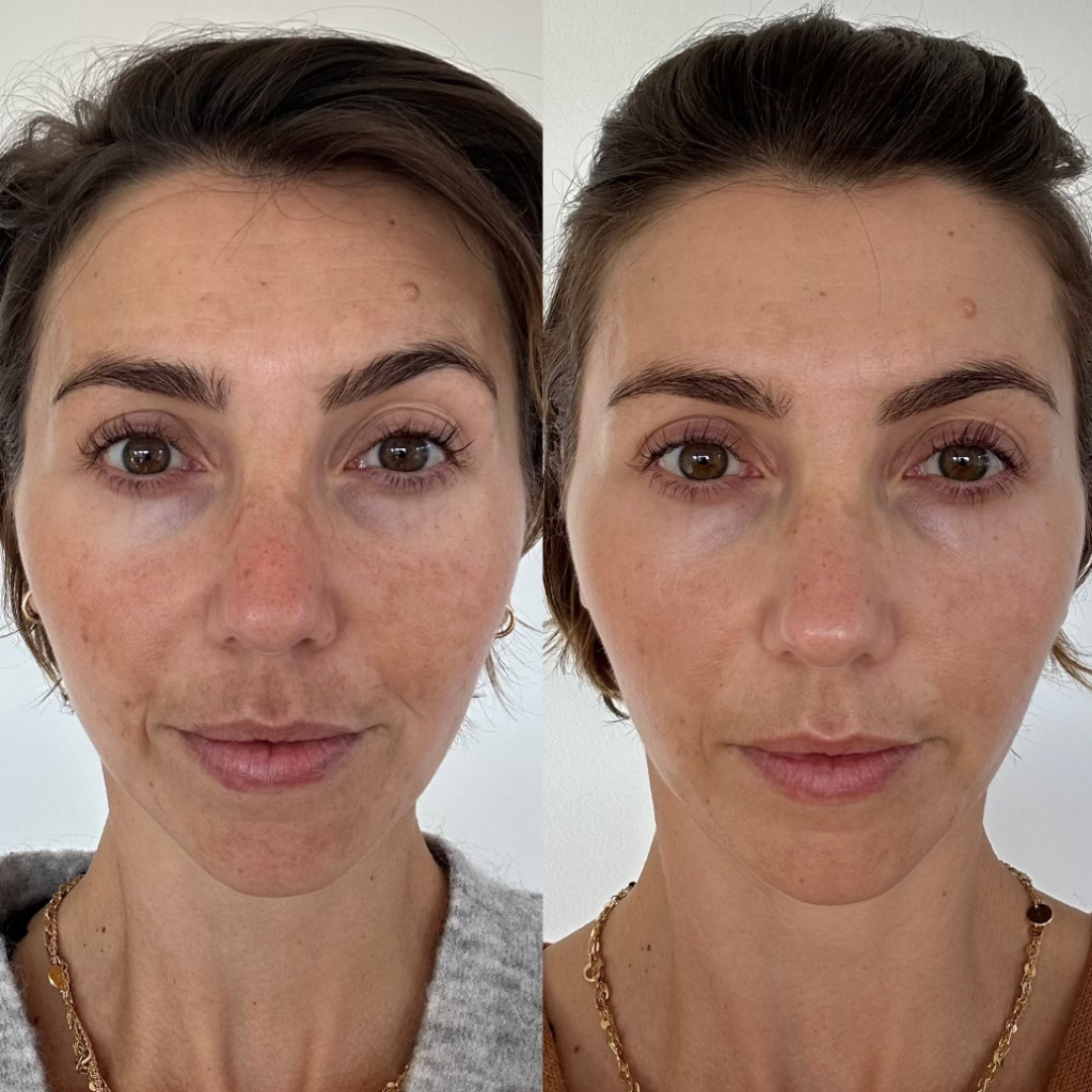 Treating Pigmentation With Skinpen Micro Needling