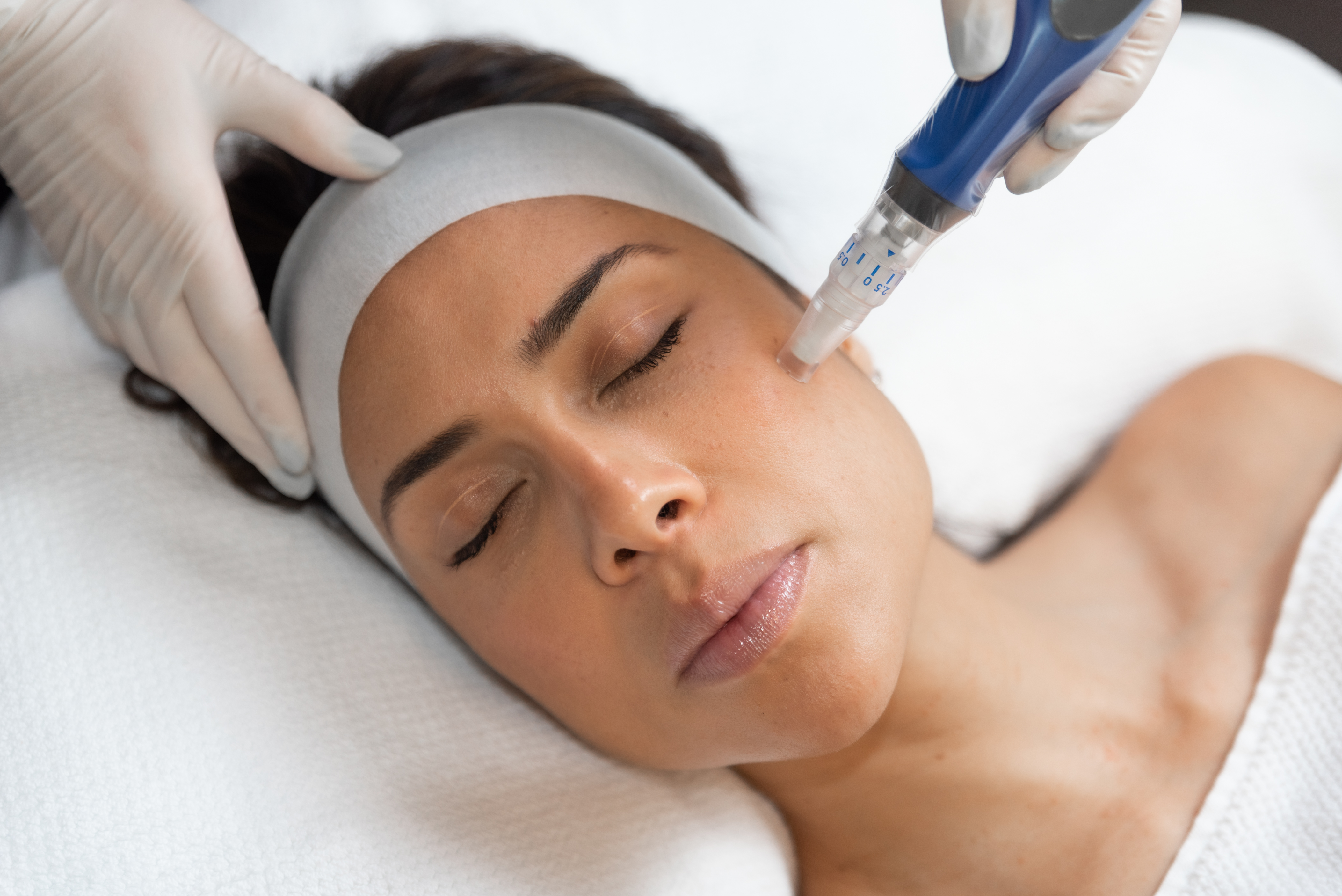 SkinPen Microneedling treatment for pigmentation, ageing and scarring
