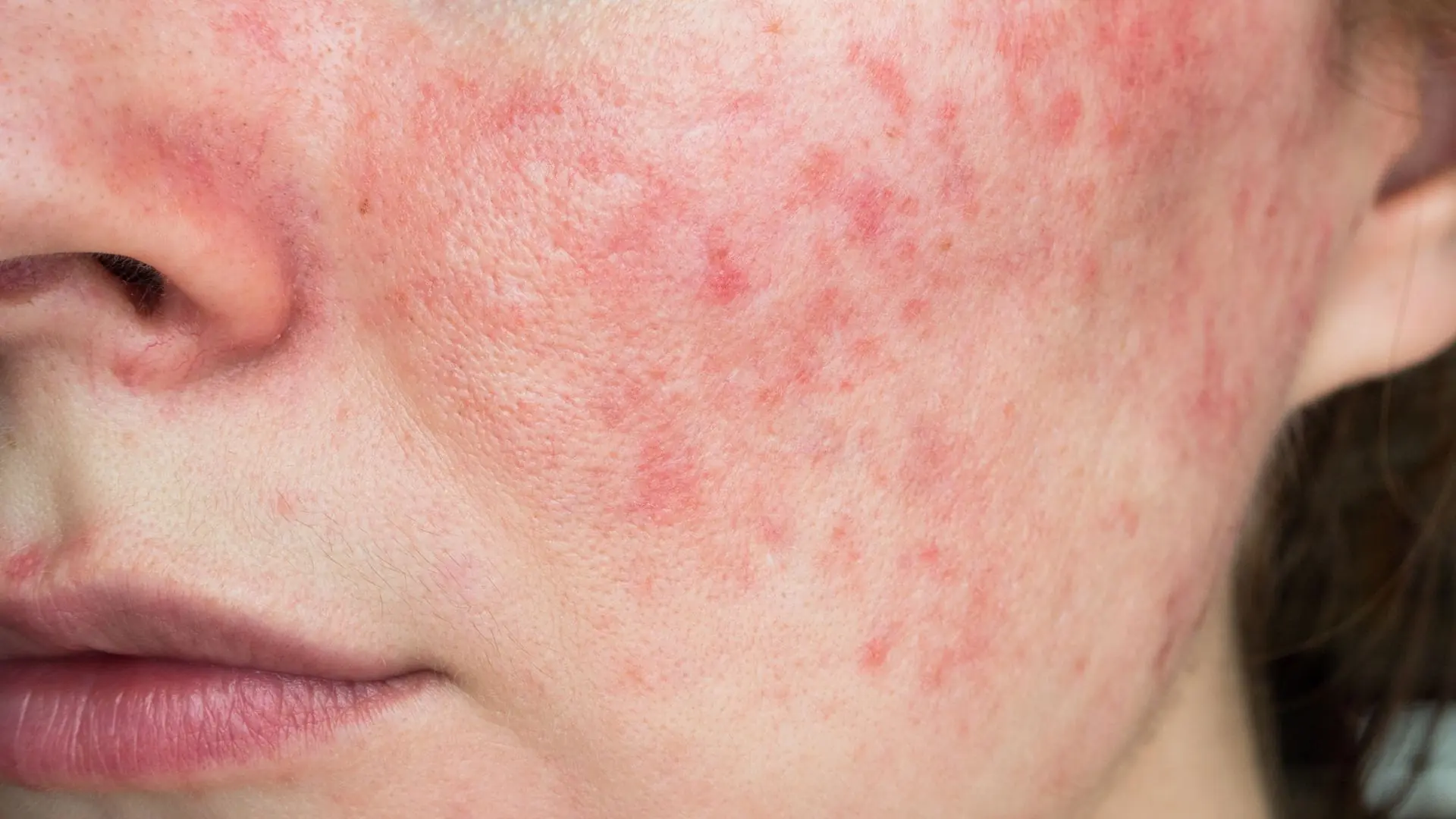 Person with inflamed skin