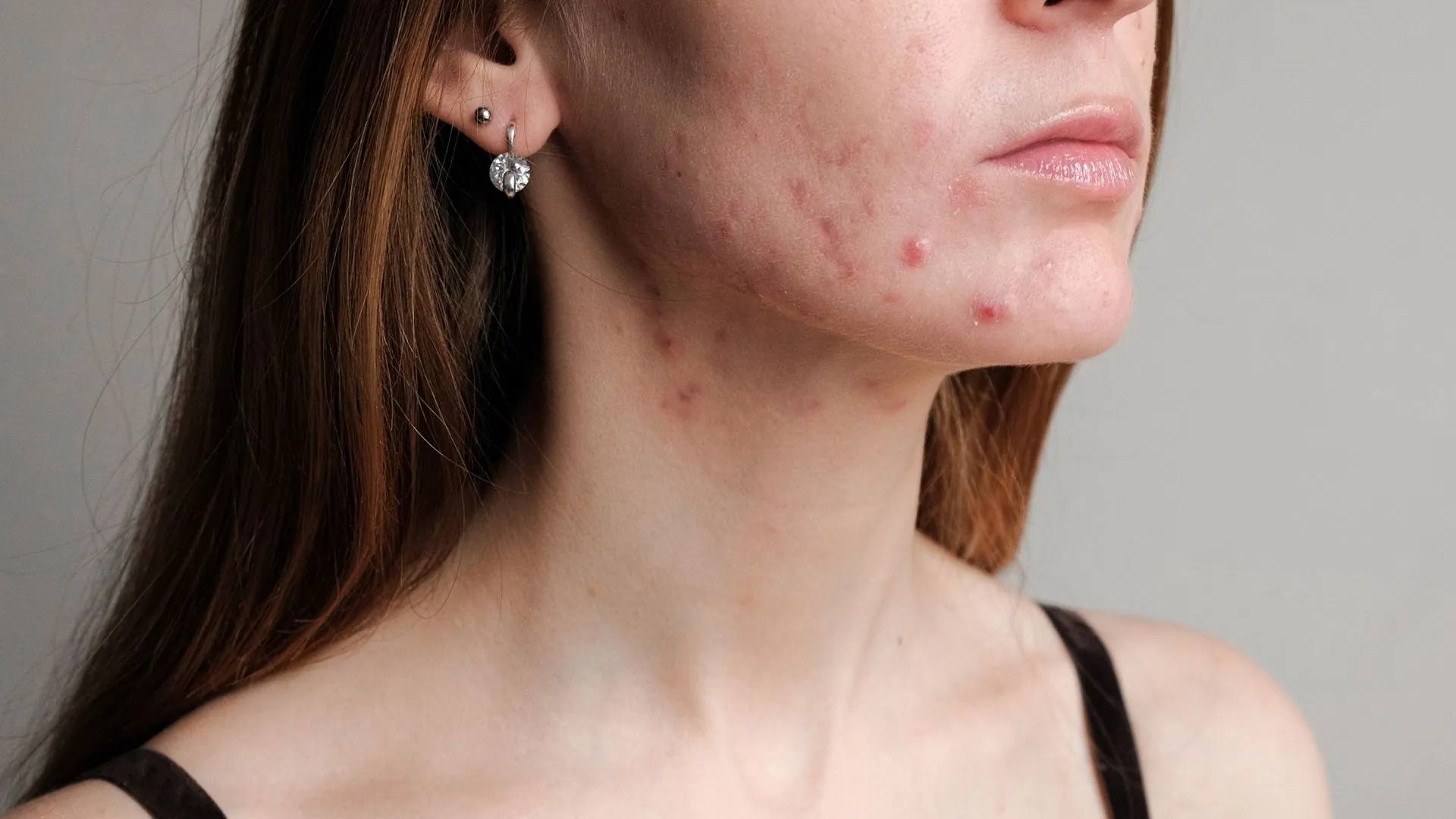 Person with acne inflammation